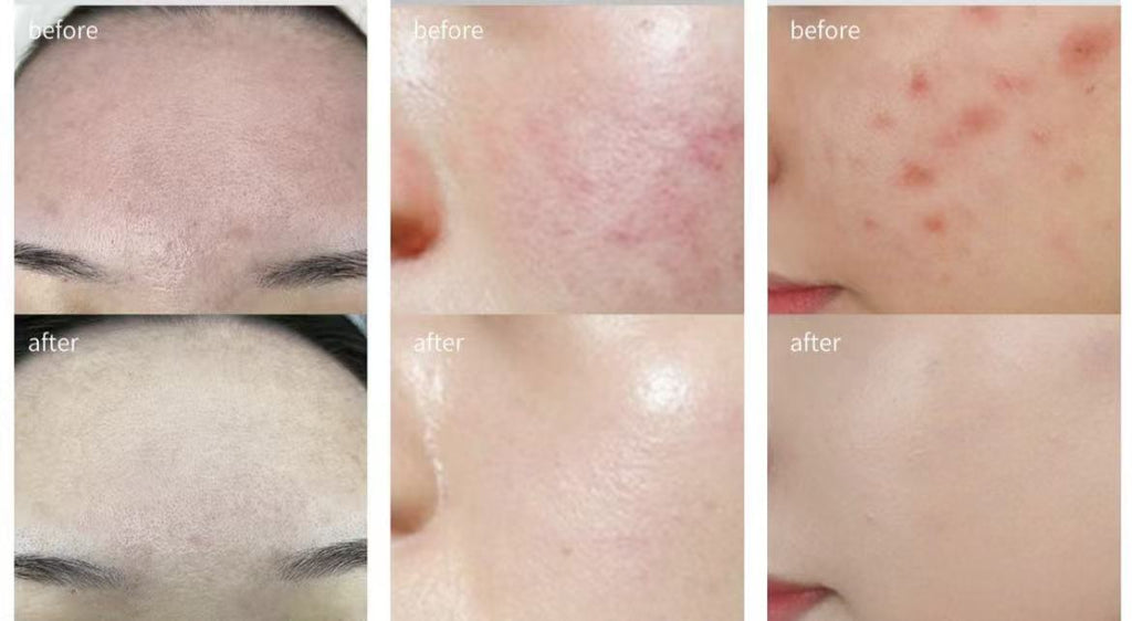 R2スピキュールキット　THEBARUM Radiance Renewing Implant Cream